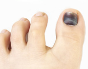 гематома на ногтях ног