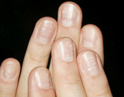 Что означают пятна на ногтях