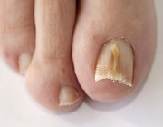 лечение ногтевого грибка на ногах народными средствами
