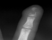 Рентгенография при панариции