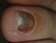 Синяк на ногте большого пальца ноги