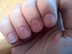 Шелушение кожи у ногтей