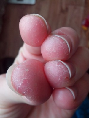 Трещины и шелушение кожи пальцев