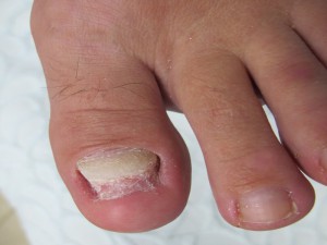 Деформация ногтей на ногах