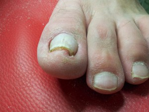Искривление ногтей на ногах