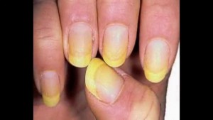 Определение болезни по ногтям рук