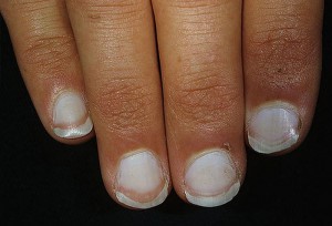 Определение болезни по ногтям рук