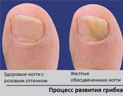 Развитие грибка ногтей