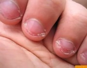 Обгрызенные ногти