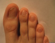 Признаки грибка на ногтях ног