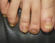 Пораженные ногти