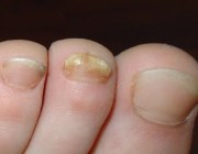 Заболевание ногтей на ногах