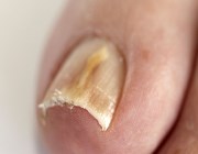 Изменение ногтевой пластины