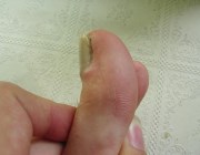 Болезни ногтей - фото и описание