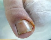 Болезни ногтей - вросший ноготь