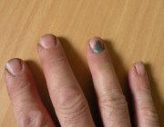 лекарства от грибка ногтей на руках