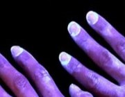 Грибок ногтей на руках симптомы