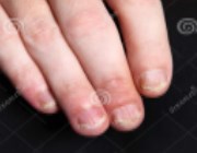 Псориаз ногтей пальцев рук