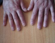 лечение псориаза ногтей в домашних условиях