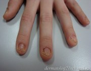 Псориаз ногтей симптомы