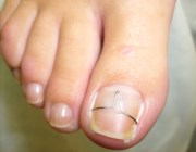 лечение вросшего ногтя лазером