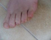 Заноза в пальце ноги