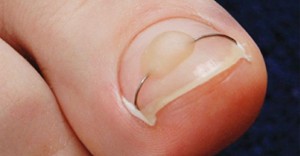 Лечение вросшего ногтя без операции