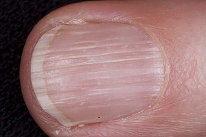 Ямки на ногтевой пластине