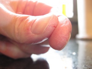 Трещины вокруг ногтей