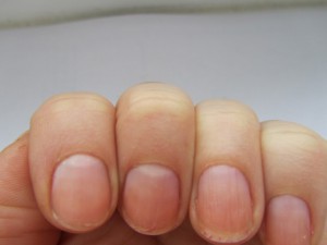 Неровные ногти