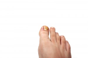 Проблема вросшего ногтя на большом пальце ноги