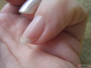 Трещина на ногтевой пластине
