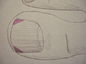 Врастание ногтя на большом пальце ноги