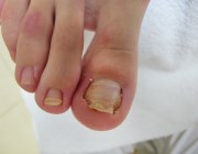 Болезни ногтей на ногах и их лечение