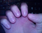 последствия грызения ногтей фото