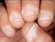 как не грызть кожу вокруг ногтей
