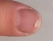 Расслоение ногтей