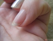 Трещины в ногтях