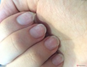 Больные ногти