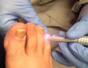 Удаление грибка ногтей лазером