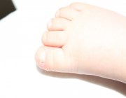 Плохие ногти на ногах у ребенка
