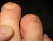 Толстые ногти на ногах лечение