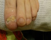 Толстые ногти на ногах лечение