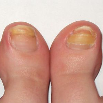 грибок ногтей на ногах - лечение