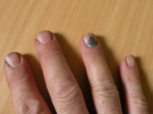 Потемнение ногтей на руках