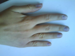 Изменение цвета ногтя