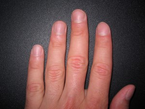 Вмятины на ногтях рук
